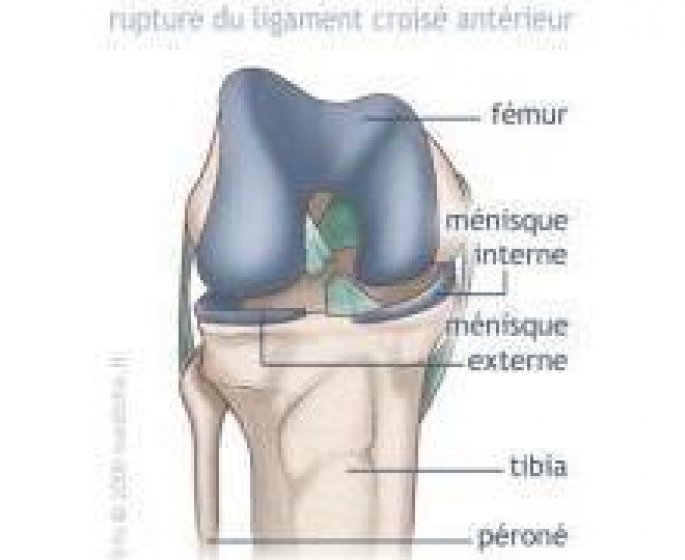 Rupture du ligament croise anterieur du genou (LCA) : Traitement chirurgical