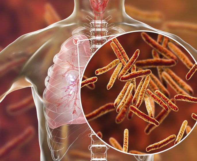 Tuberculose : un cas confirme dans le Pas-de-Calais