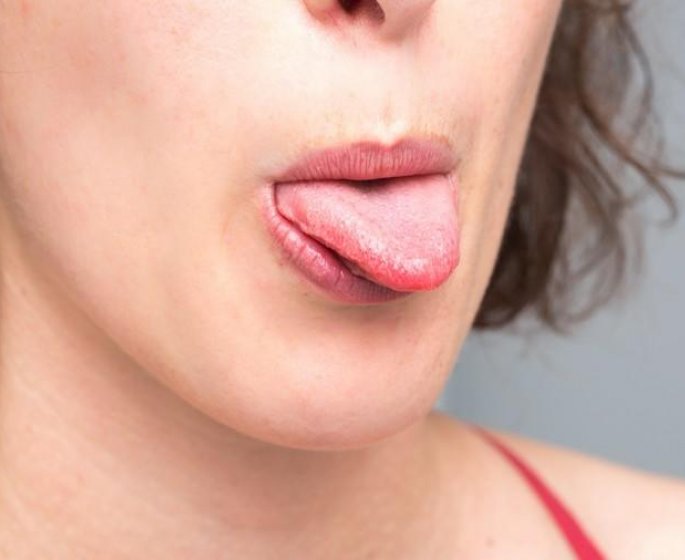 7 maladies que l-on peut attraper par la salive