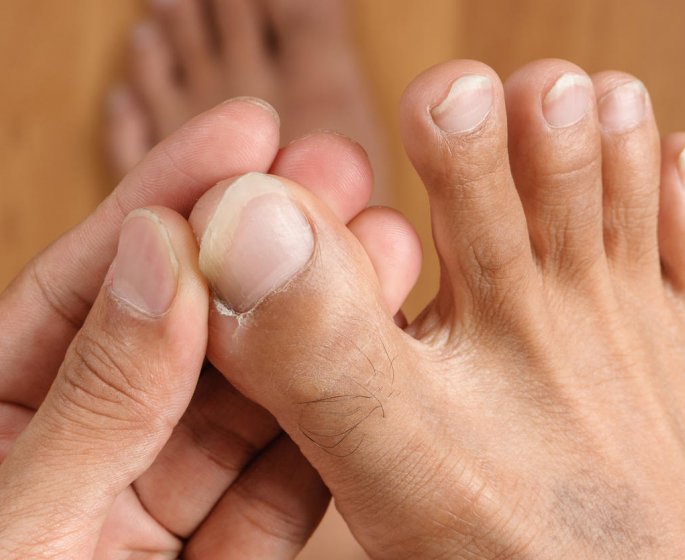 Fusidate de sodium : peut-on l-utiliser pour soigner un panaris ?