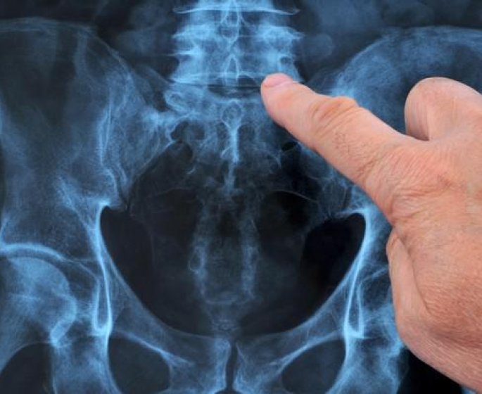 Discopathie degenerative, L5 S1, L4 L5, lombaire : comment la soigner ?