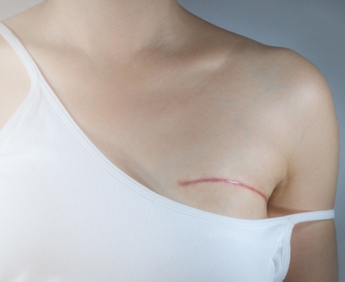 Cancer du sein : comment se deroule la reeducation ? 