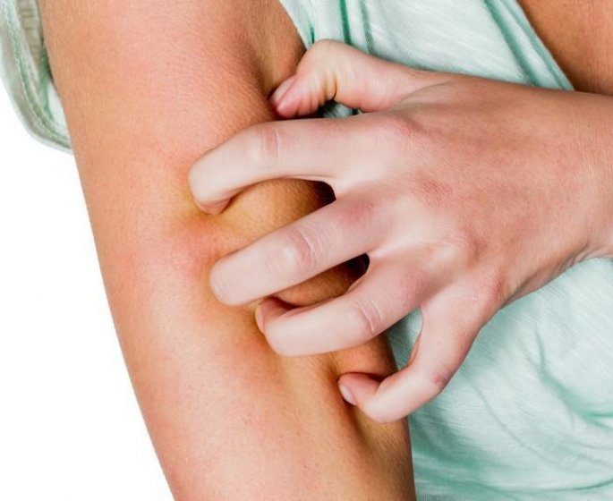 Gonflement et allergie aux piqures de moustique : que faire ?