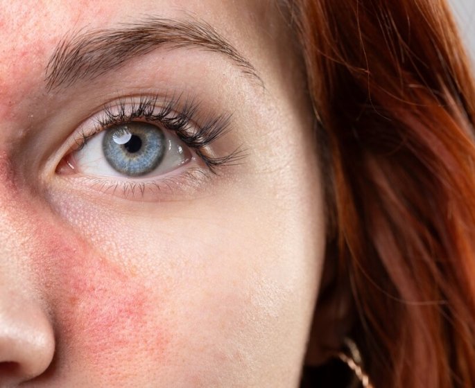 Des traitements contre la rosacee et l-acne cancerigenes si mal conserves ! 