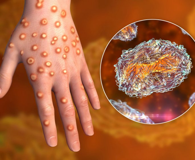 Variole du singe : comment se faire tester du virus Monkeypox ? 