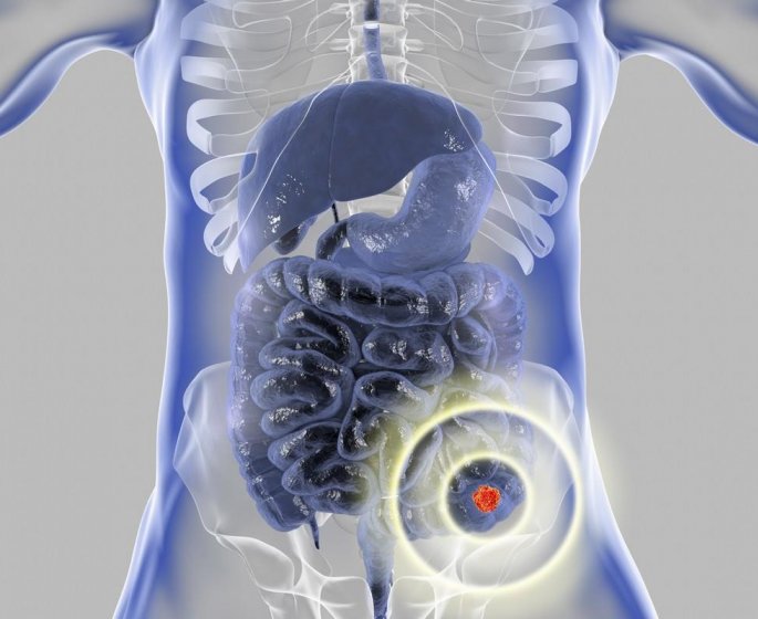 Cancer du colon : le nombre de cas parmi vos proches influence votre risque