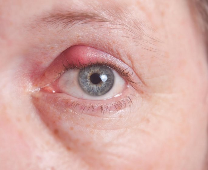 Chalazion (kyste de la paupiere) : causes, symptomes, traitements