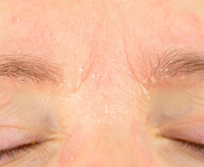 Eczema du visage : causes, traitements et comment eviter les crises ?