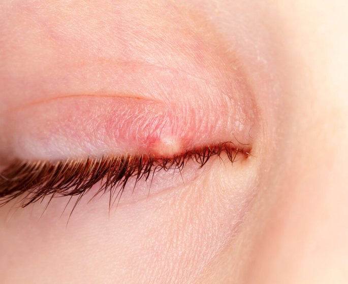 Orgelet, chalazion, conjonctivite : comment les reconnaitre ?