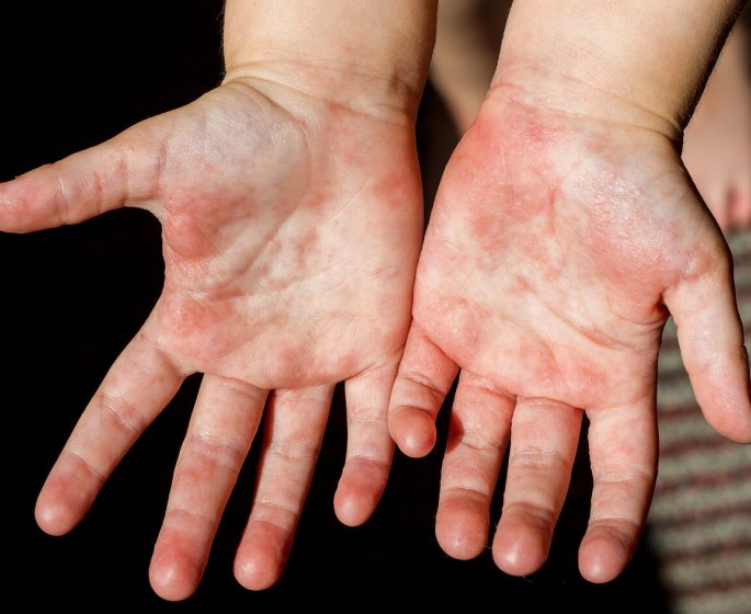 Scarlatine : quelle est son origine ?