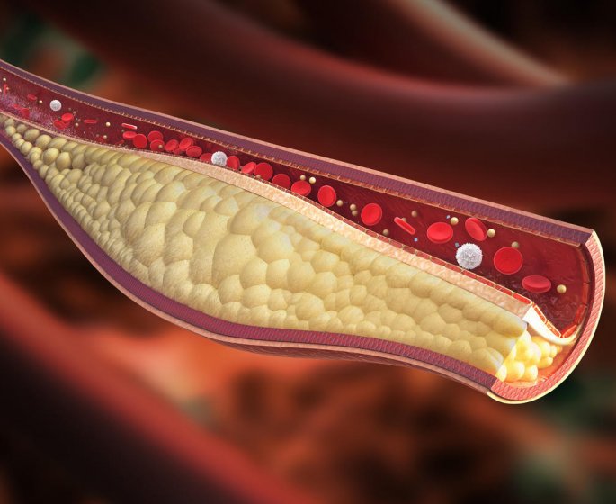 Atherosclerose et cholesterol : le lien