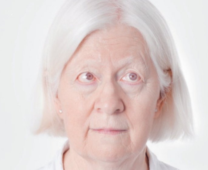 Albinisme : “l’humour de mon papa m’a permis d’accepter ma difference”