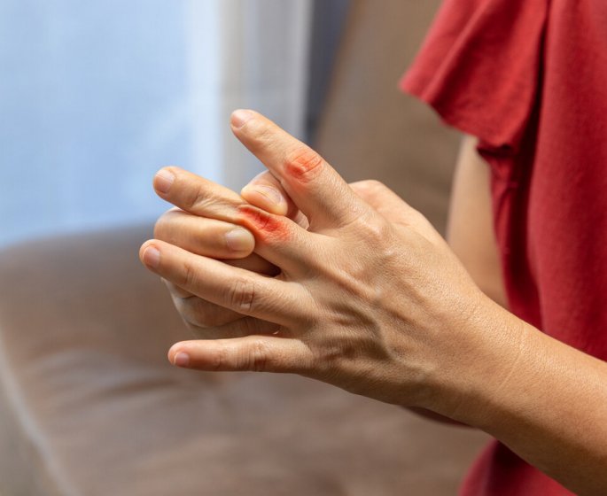 Ces 2 signes sur vos mains pourraient annoncer une maladie cardiovasculaire