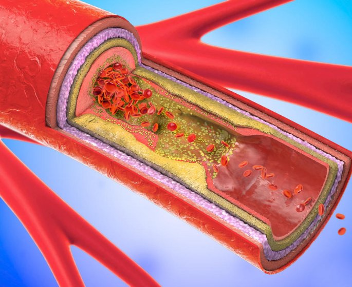 Atherosclerose : le traitement chirurgical