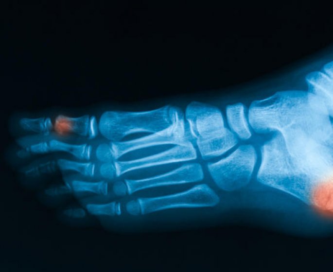 Scintigraphie osseuse du pied : comment cela se passe ?