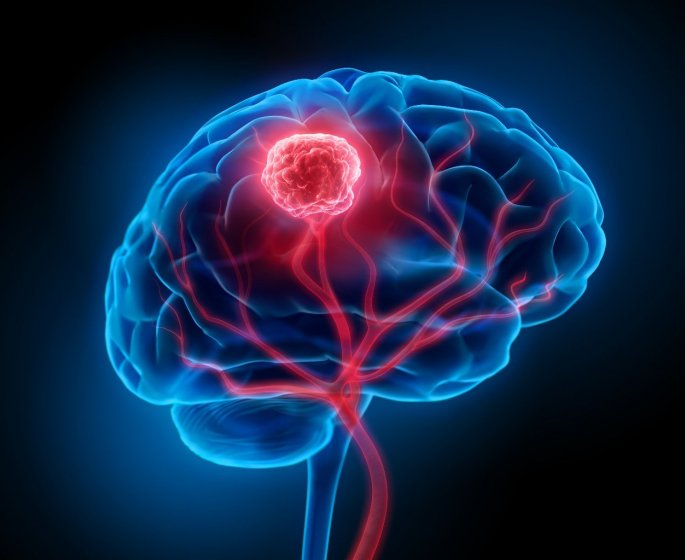 Cancer : sa main engourdie etait en fait une tumeur cerebrale mortelle