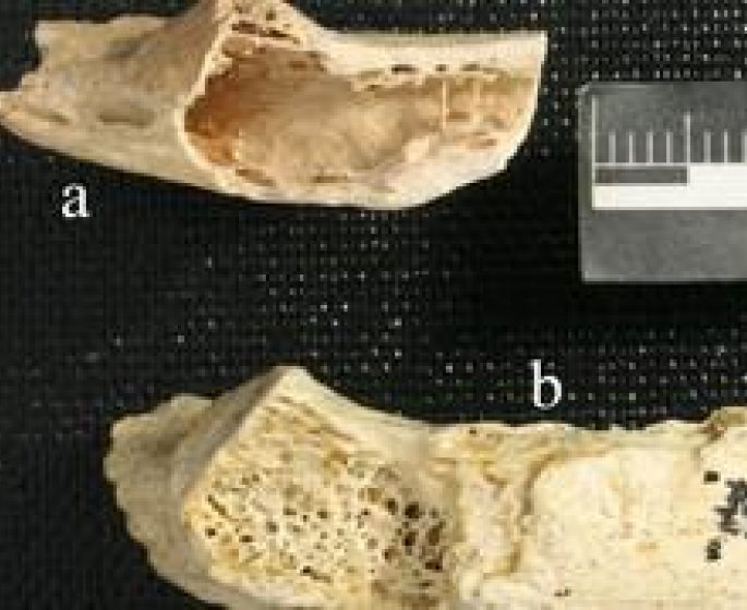 La plus vieille tumeur du monde a 120 000 ans !