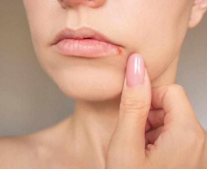 Alzheimer : Le virus de l-herpes serait-il implique dans sa survenue ?