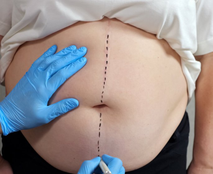 Obesite : une nouvelle procedure pour perdre jusqu’a 79% de la prise de poids