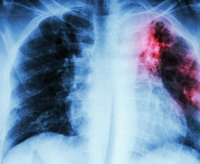 Mucoviscidose : causes, traitements et pistes de recherche