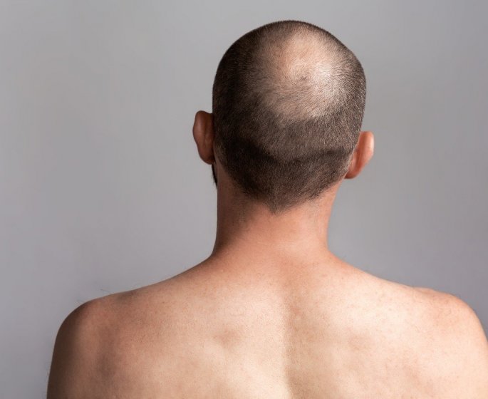 6 astuces pour camoufler une calvitie