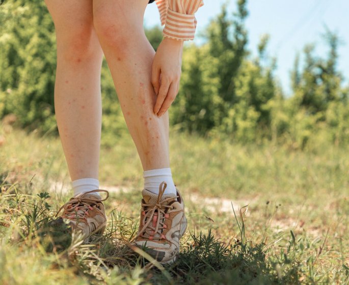 Piqures de moustiques : l’astuce insolite d’une dermatologue contre les demangeaisons