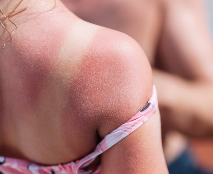 Coups de soleil chez l-enfant : quelles consequences a l-age adulte ?