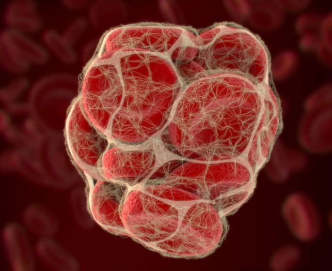 Embolie pulmonaire : le traitement anticoagulant