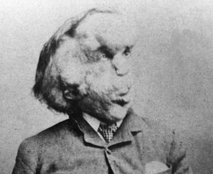 Grace a Elephant Man, on pourrait mieux comprendre les causes du cancer