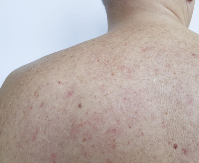 Petechies : est-ce un signe d-allergie au soleil ?