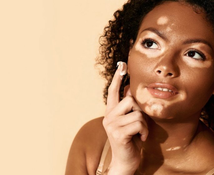 Vitiligo : premier traitement pour la repigmentation de la peau