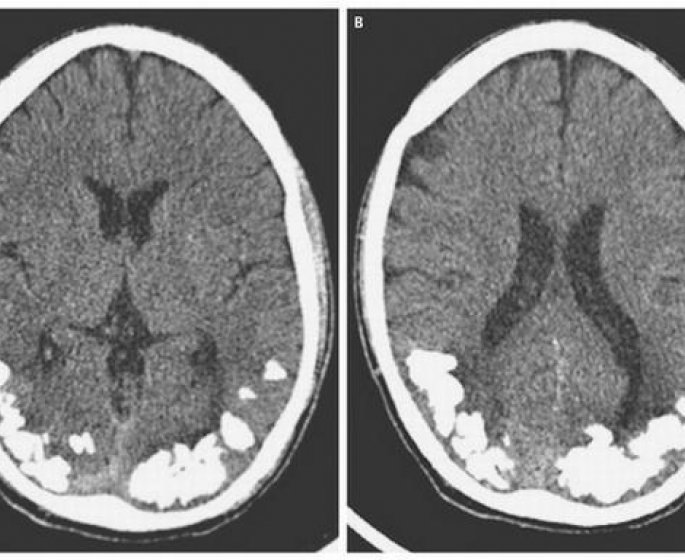 Des cailloux de calcium dans son cerveau a l’origine de ses migraines