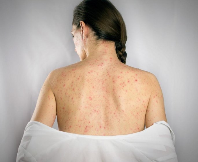 Variole du singe (mpox) : 6 conseils pour limiter sa propagation