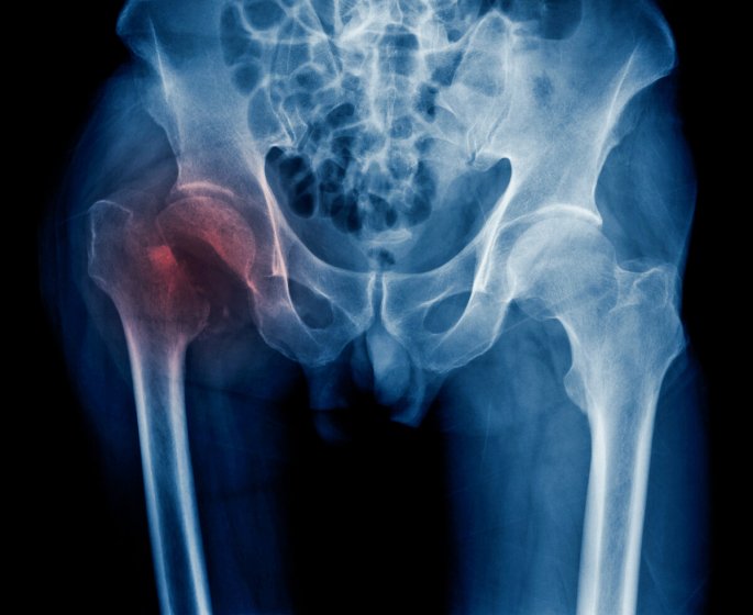 Fracture de la hanche : des habitudes simples peuvent reduire les risques