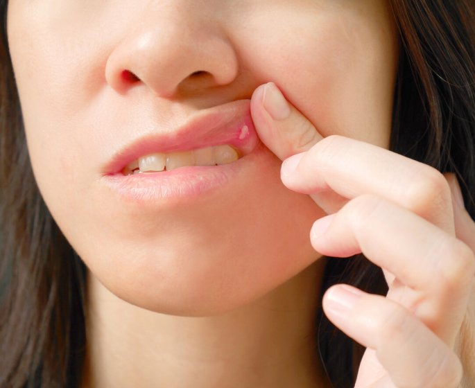 Aphte sur la langue : symptomes, causes, solutions