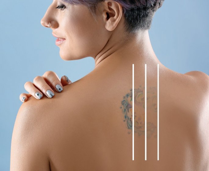Detatouage laser : 10 stars qui ont fait enlever leur tatouage