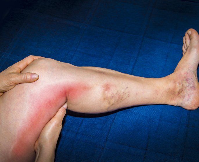 Maladie veineuse thromboembolique : les 15 departements les plus touches