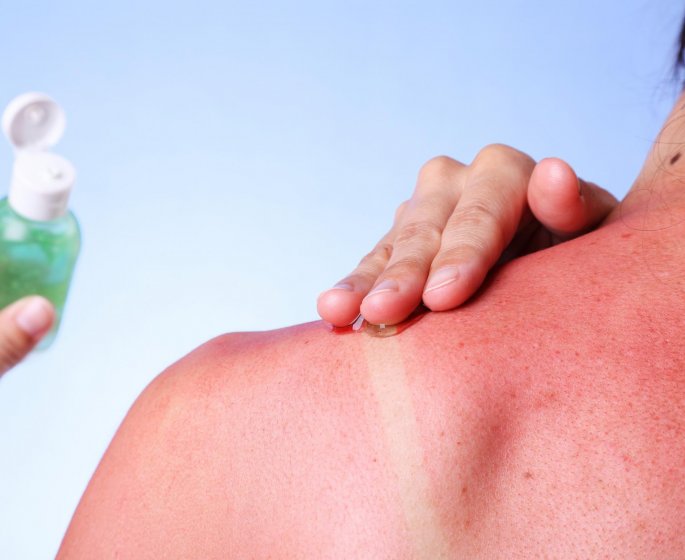 8 remedes naturels anti coup de soleil