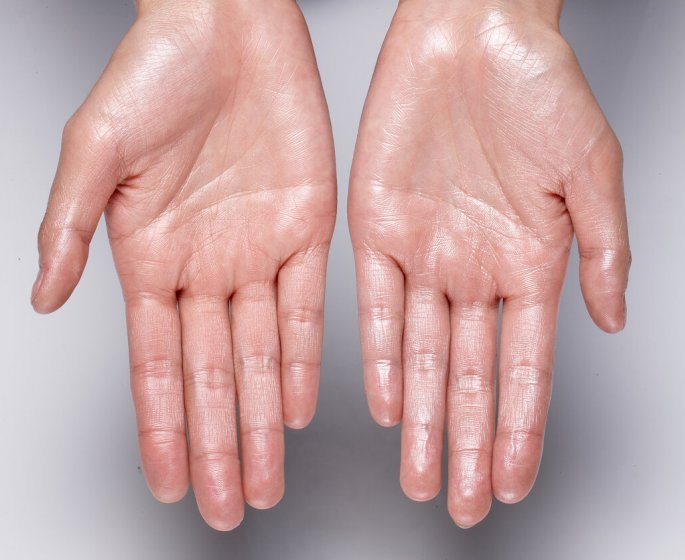 Transpiration des pieds et des mains : connaissez-vous l-ionophorese ? Cette technique est ultra efficace !