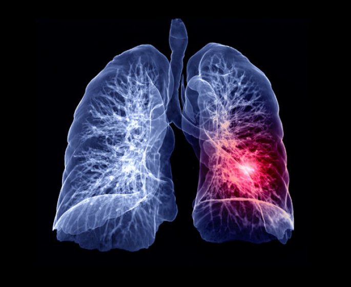 Cancer du poumon : votre risque selon la region ou vous habitez