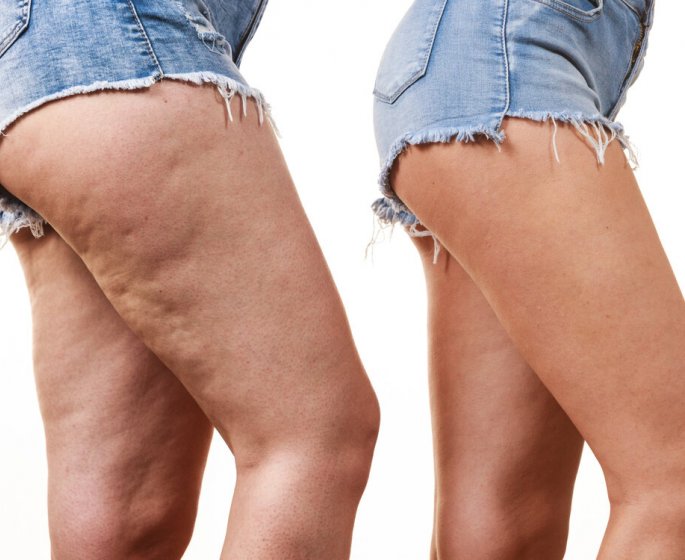 Cellulite : 5 astuces naturelles pour la reduire