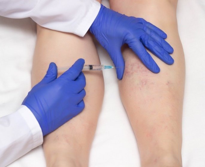 Traitement des varices : 8 effets indesirables a surveiller, selon l-ANSM