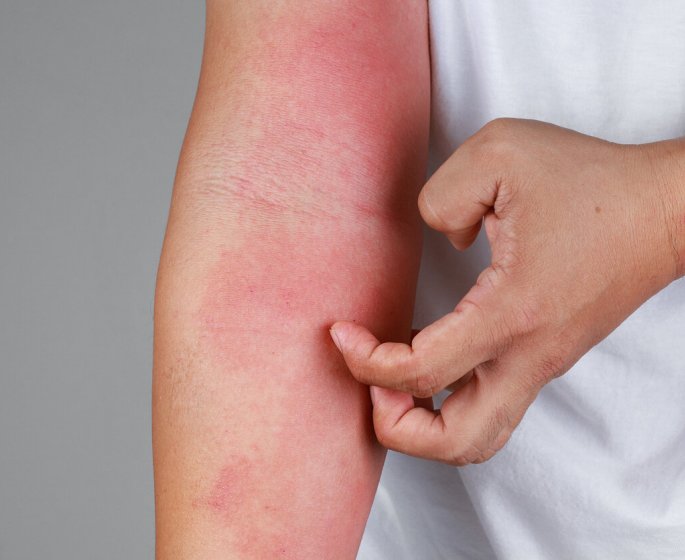 Quel est le lien entre allergie alimentaire et medicaments ?