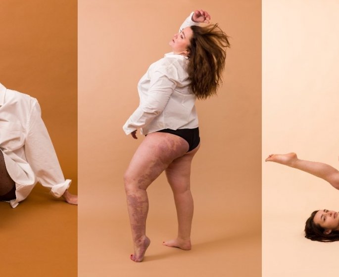 Cicatrices, poils... 16 femmes devoilent leurs jambes sans complexe