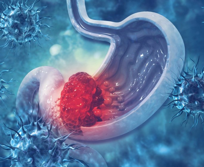 Cancer de l-estomac : 8 signes qui apparaissent precocement 