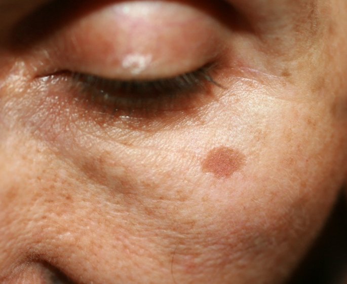 Taches brunes : 6 solutions naturelles pour les eliminer