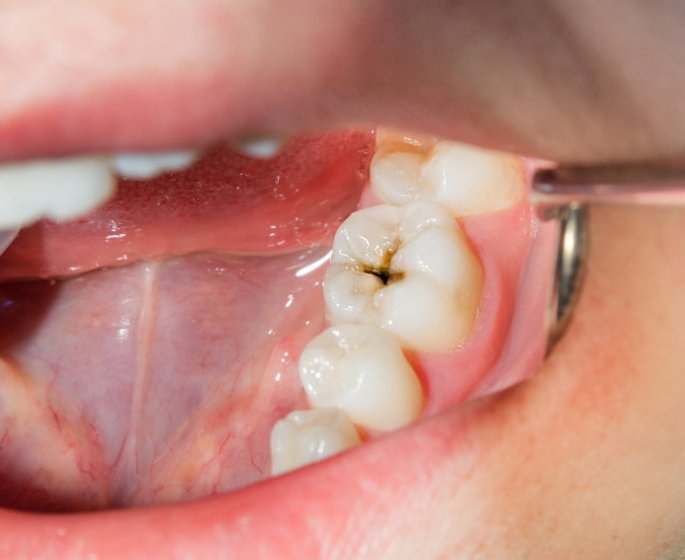 Caries : 10 aliments qui les favorisent