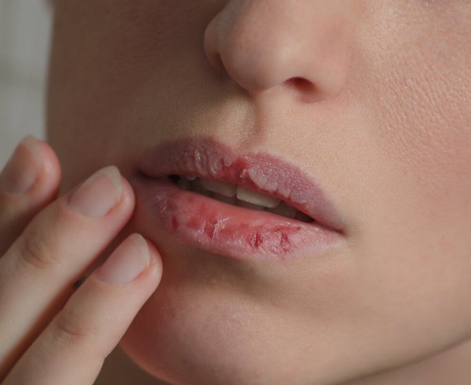 C’est quoi, le syndrome de Sjogren ?
