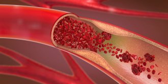 Phlebite ou thrombose veineuse (mollet, jambe...) : symptomes et traitements