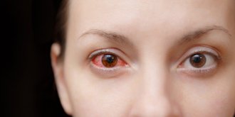 Conjonctivite virale : symptomes, duree, traitements, contagion